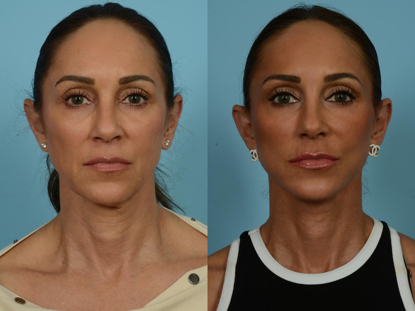 Before & After Dual Plane Facelift by Dr. Sinno Case 860 Front View in Chicago, IL