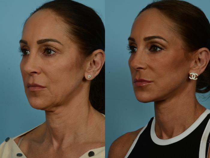 Before & After Dual Plane Facelift by Dr. Sinno Case 860 Left Oblique View in Chicago, IL