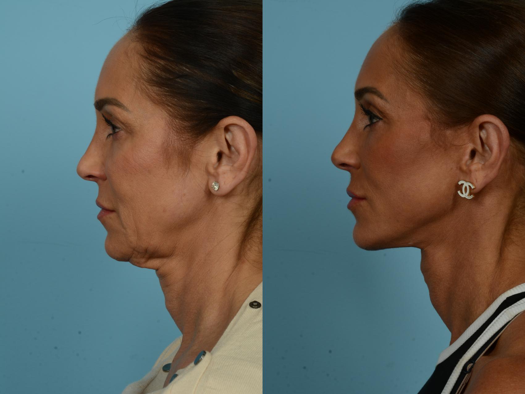 Before & After Dual Plane Facelift by Dr. Sinno Case 860 Left Side View in Chicago, IL