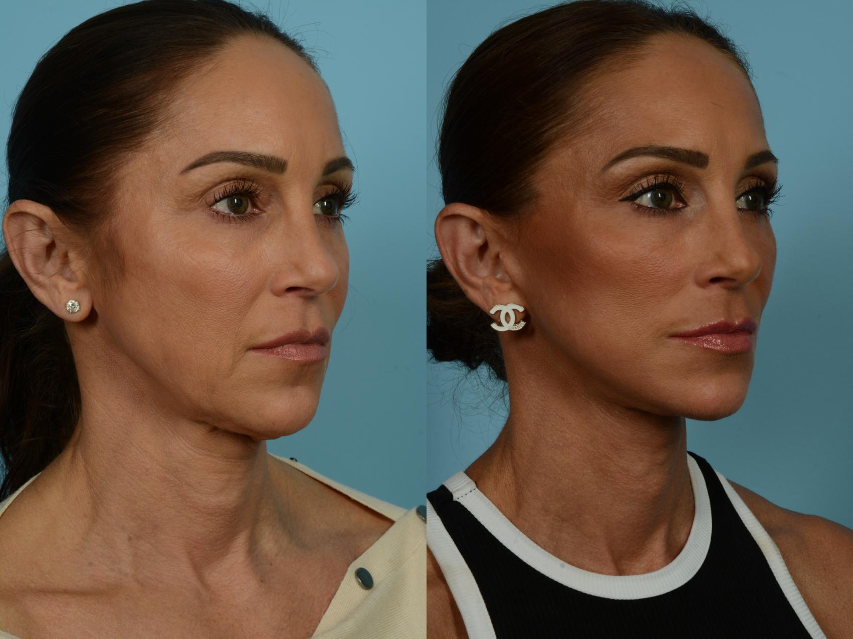 Before & After Dual Plane Facelift by Dr. Sinno Case 860 Right Oblique View in Chicago, IL