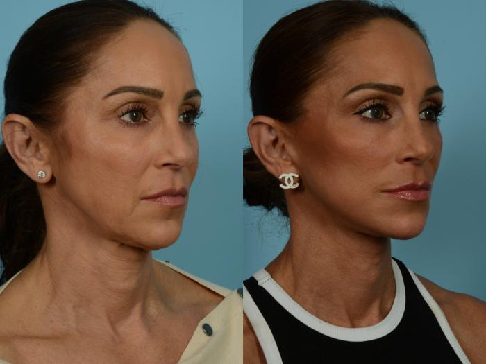 Before & After Dual Plane Facelift by Dr. Sinno Case 860 Right Oblique View in Chicago, IL