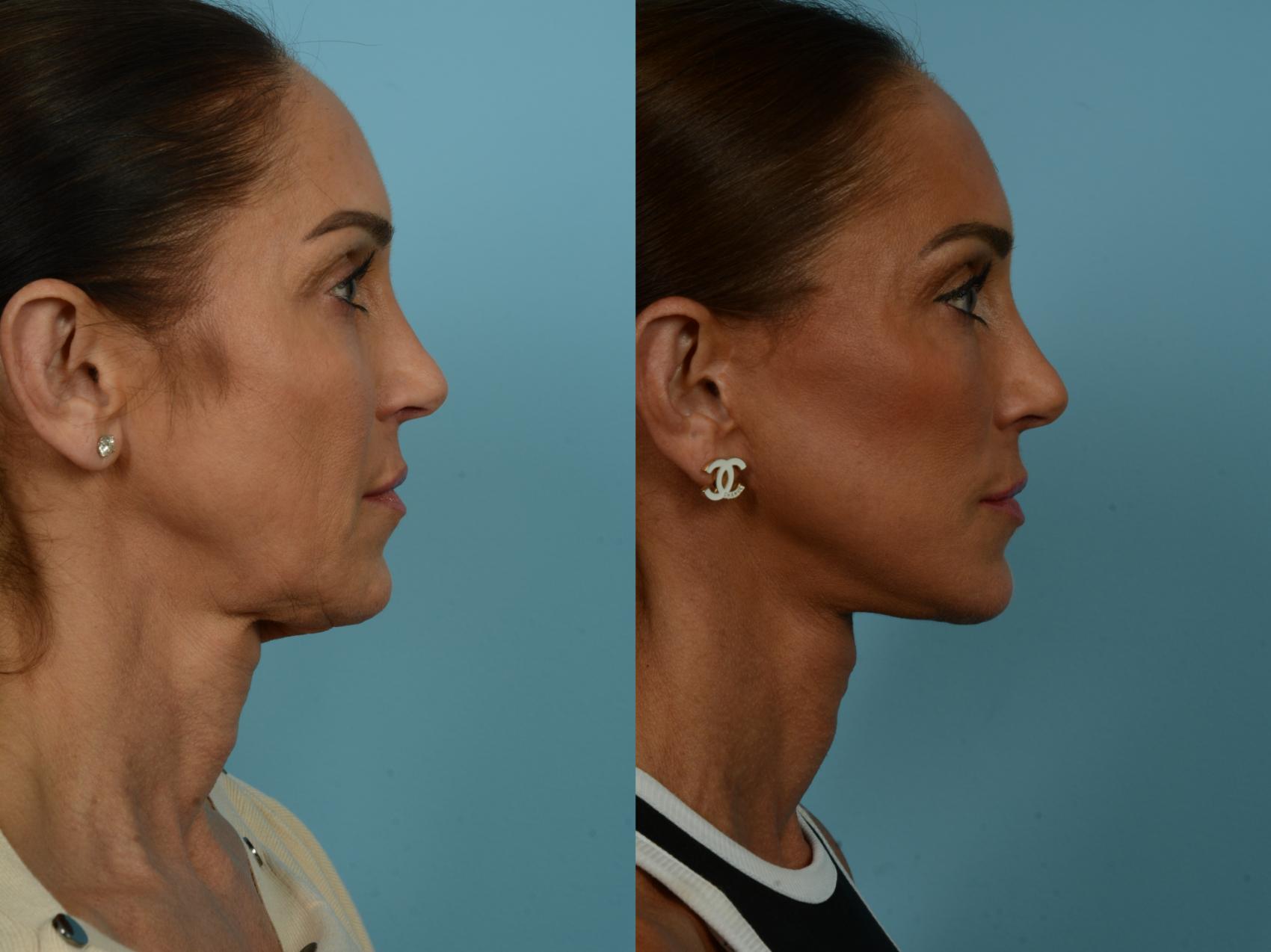 Before & After Dual Plane Facelift by Dr. Sinno Case 860 Right Side View in Chicago, IL