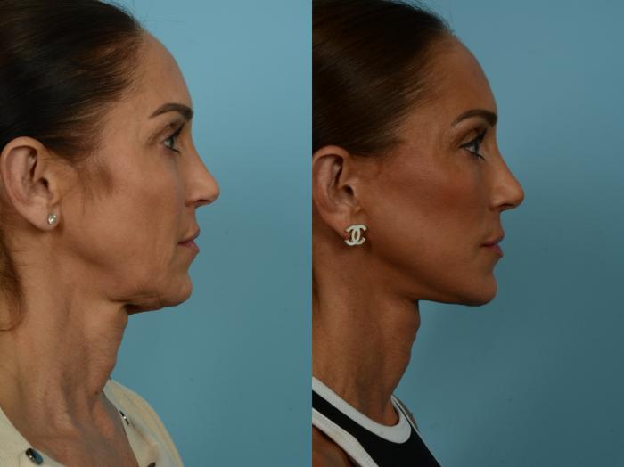 Before & After Dual Plane Facelift by Dr. Sinno Case 860 Right Side View in Chicago, IL