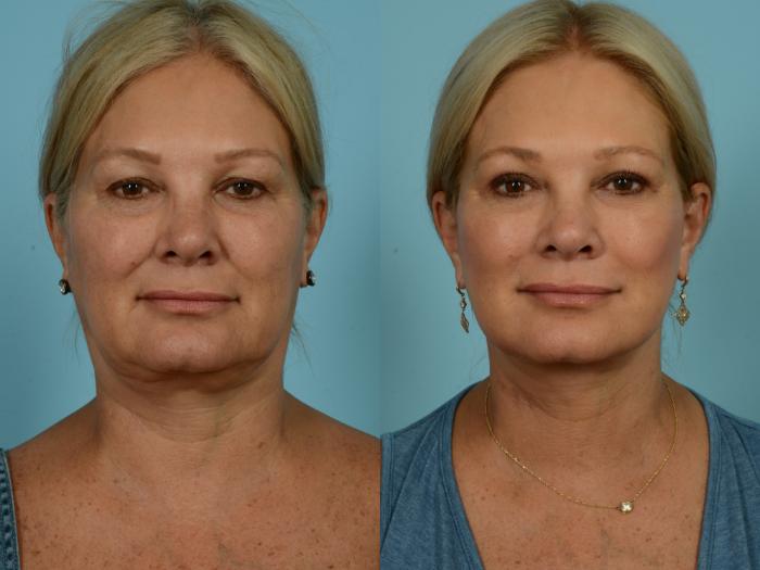 Before & After Neck Lift by Dr. Sinno Case 869 Front View in Chicago, IL