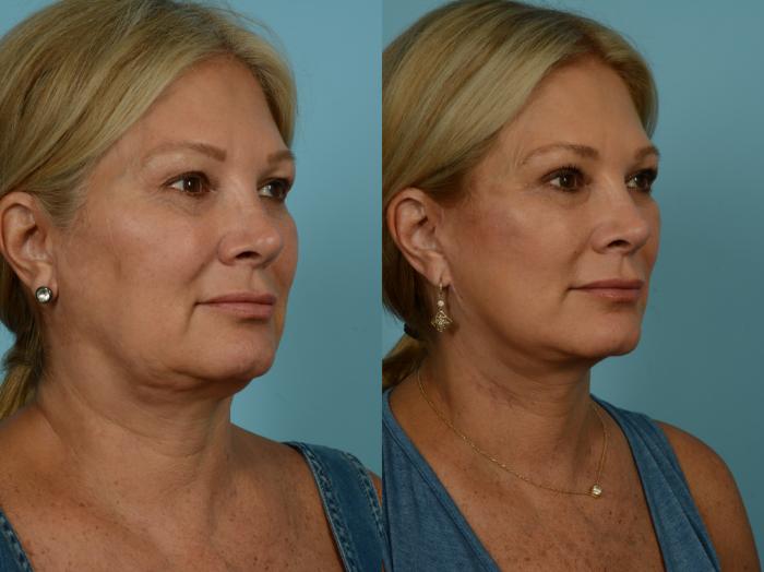 Before & After Neck Lift by Dr. Sinno Case 869 Right Oblique View in Chicago, IL
