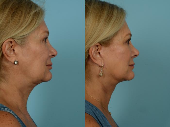 Before & After Neck Lift by Dr. Sinno Case 869 Right Side View in Chicago, IL
