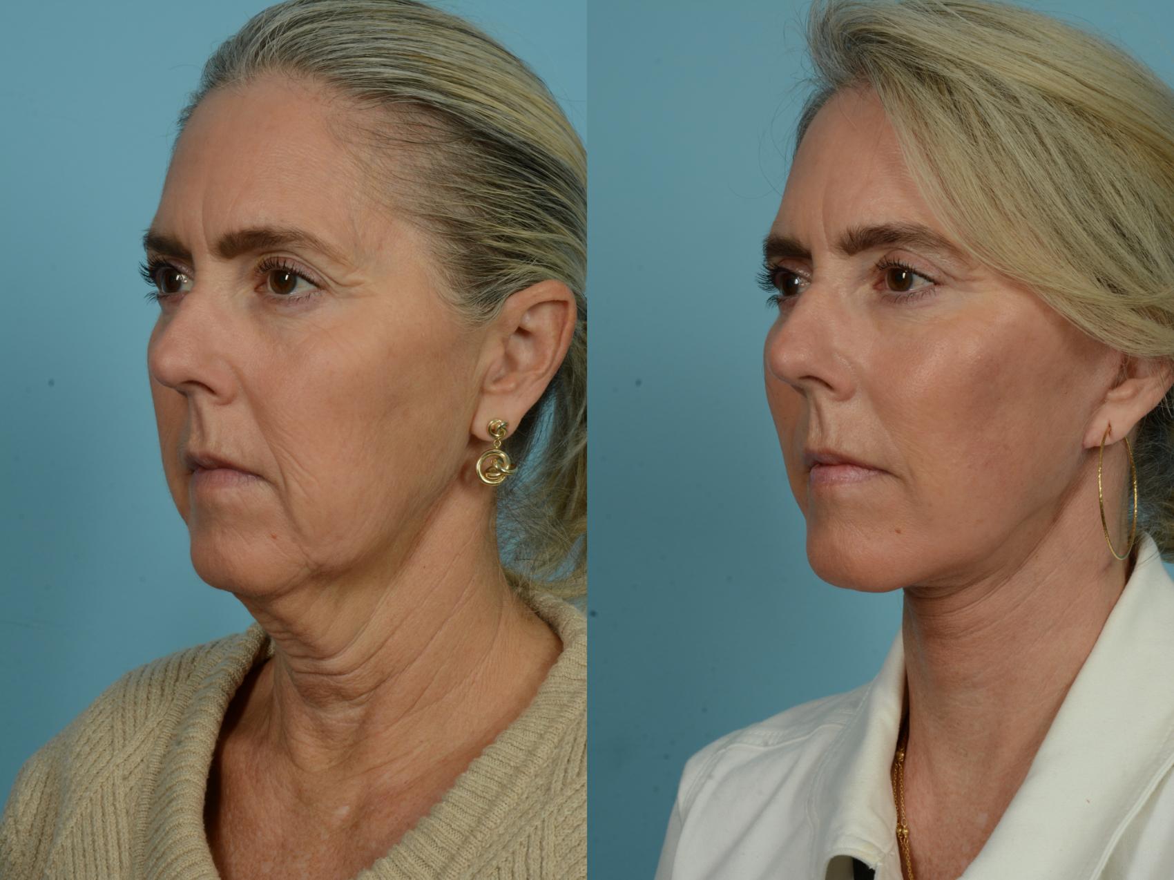 Before & After Dual Plane Facelift by Dr. Sinno Case 876 Left Oblique View in Chicago, IL