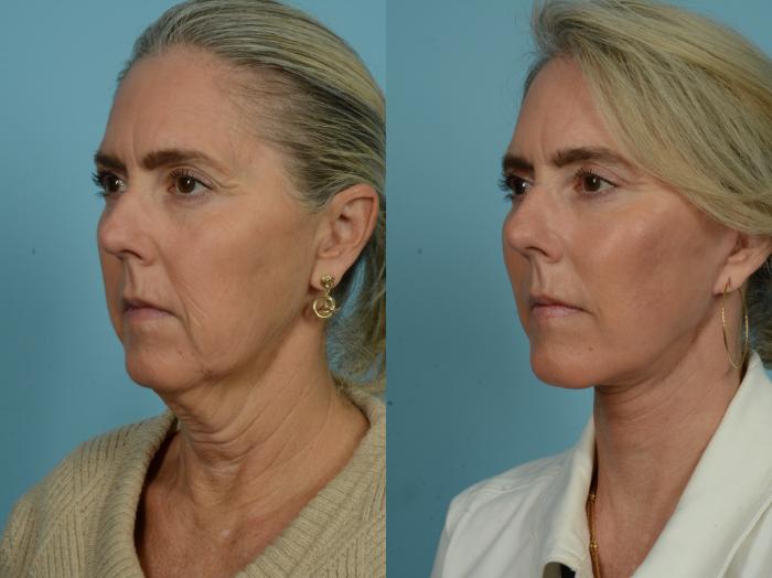 Before & After Dual Plane Facelift by Dr. Sinno Case 876 Left Oblique View in Chicago, IL