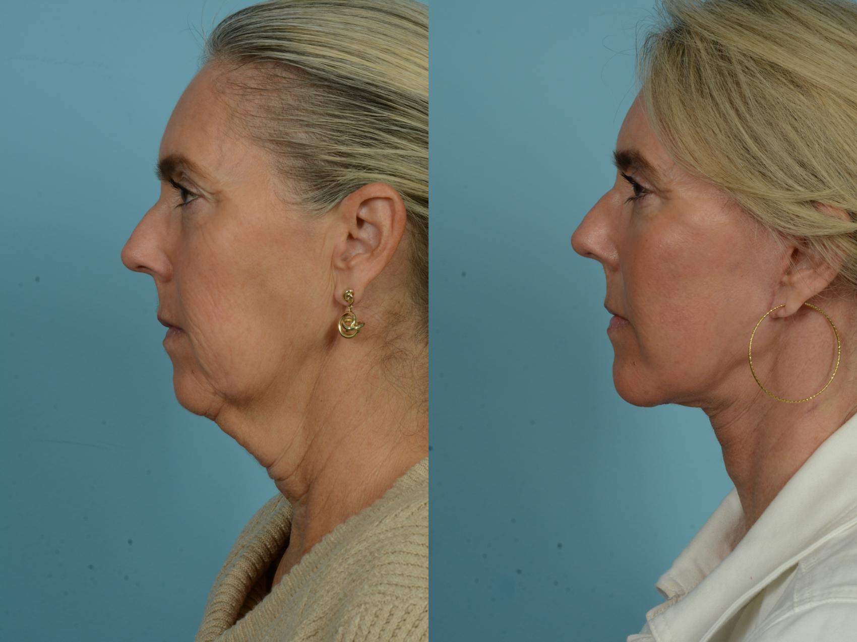 Before & After Dual Plane Facelift by Dr. Sinno Case 876 Left Side View in Chicago, IL