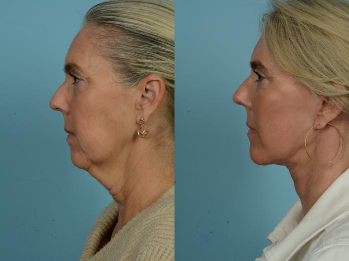 Before & After Dual Plane Facelift by Dr. Sinno Case 876 Left Side View in Chicago, IL