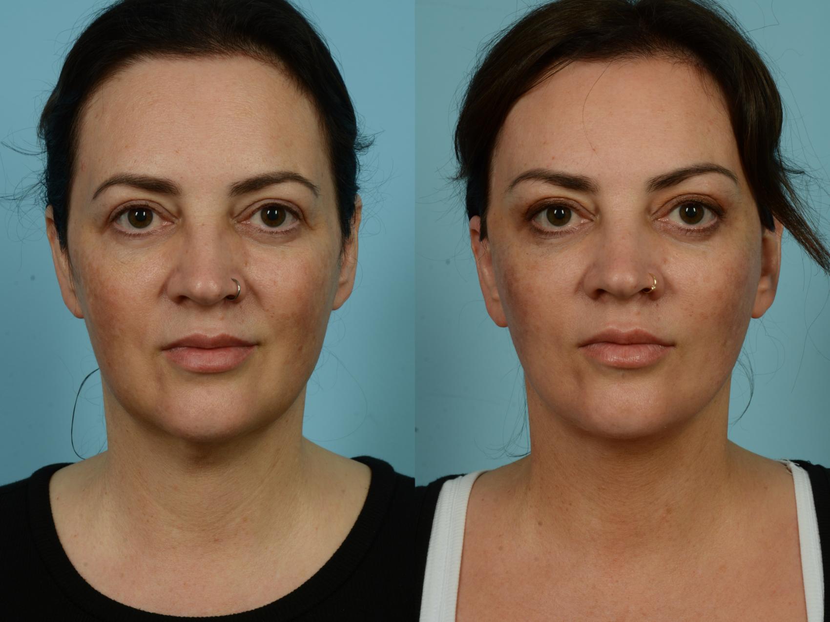 Before & After Dual Plane Facelift by Dr. Sinno Case 877 Front View in Chicago, IL