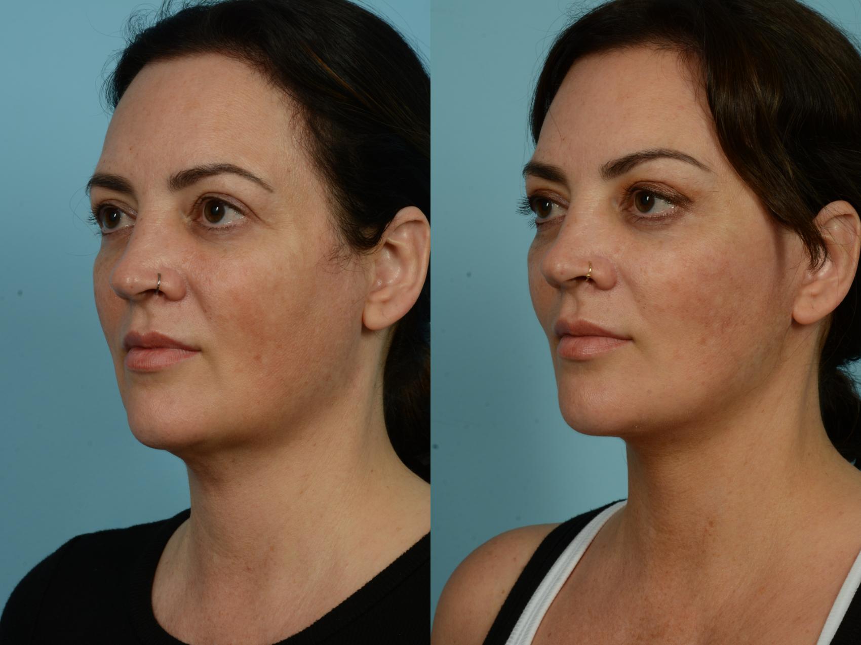 Before & After Dual Plane Facelift by Dr. Sinno Case 877 Left Oblique View in Chicago, IL