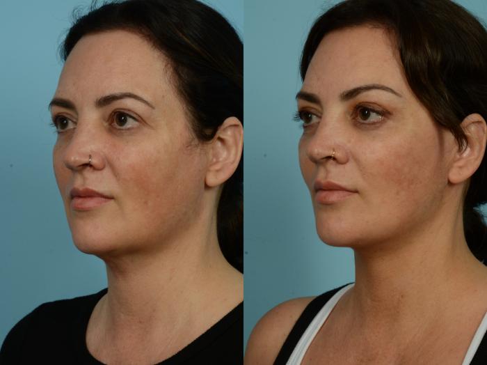Before & After Dual Plane Facelift by Dr. Sinno Case 877 Left Oblique View in Chicago, IL