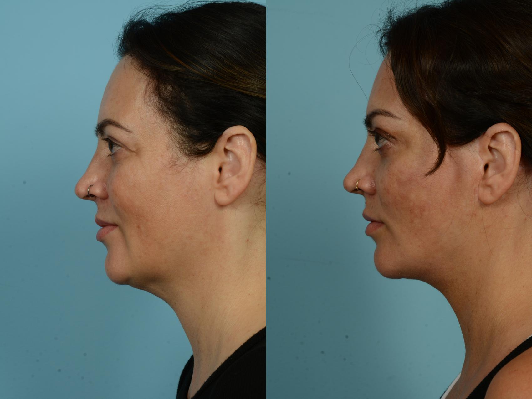 Before & After Dual Plane Facelift by Dr. Sinno Case 877 Left Side View in Chicago, IL