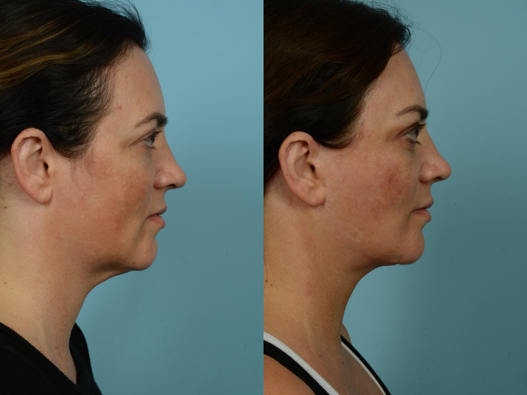 Before & After Dual Plane Facelift by Dr. Sinno Case 877 Right Side View in Chicago, IL