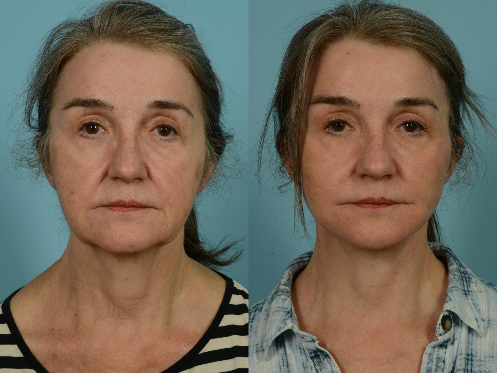 Before & After Dual Plane Facelift by Dr. Sinno Case 970 Front View in Chicago, IL