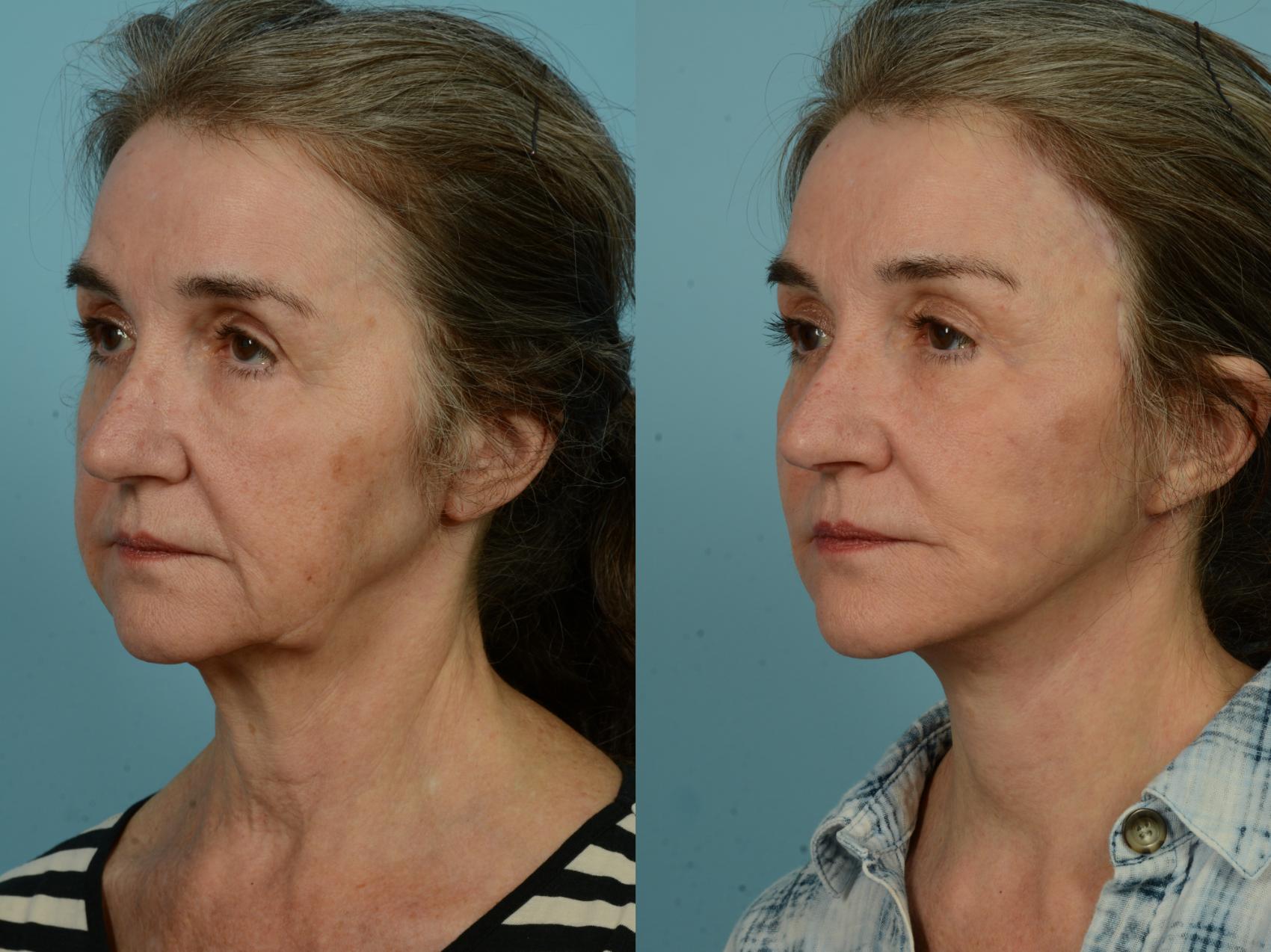 Before & After Dual Plane Facelift by Dr. Sinno Case 970 Left Oblique View in Chicago, IL