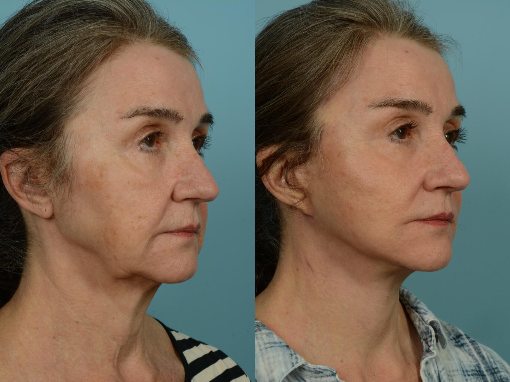 Before & After Dual Plane Facelift by Dr. Sinno Case 970 Right Oblique View in Chicago, IL