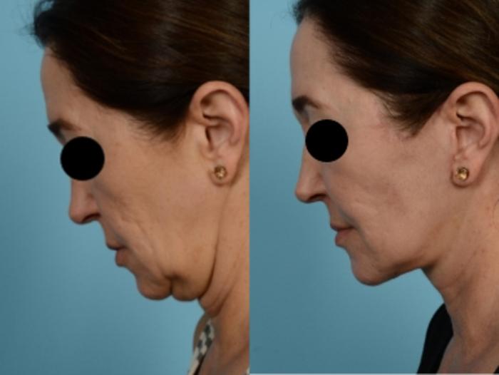 Dr. Sinno Facelift in Chicago, Illinois