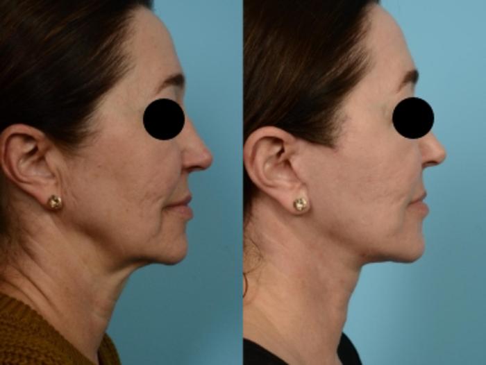 Dr. Sinno Facelift in Chicago, Illinois
