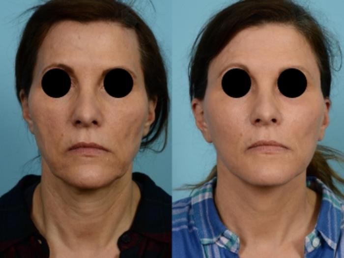 Dr. Sinno Facelift in Chicago, Illinois