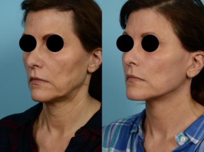 Dr. Sinno Facelift in Chicago, Illinois