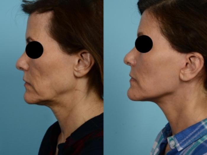Dr. Sinno Facelift in Chicago, Illinois