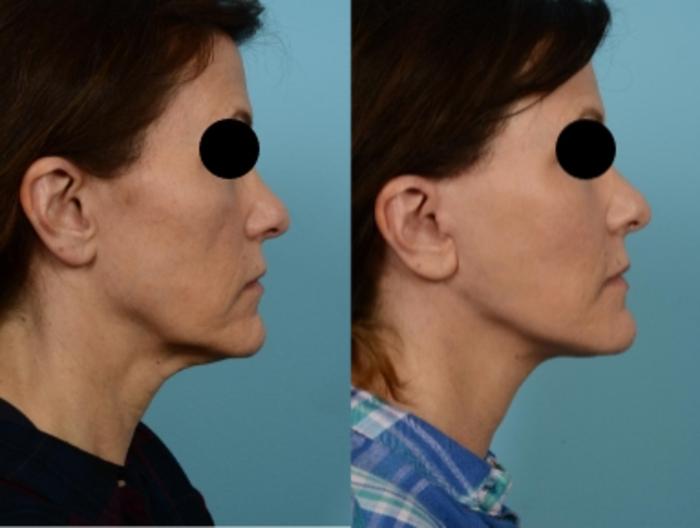 Dr. Sinno Facelift in Chicago, Illinois