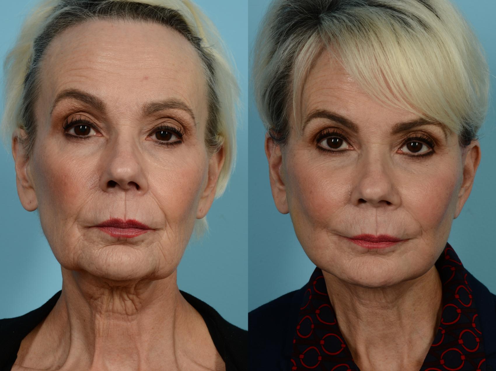 Dr. Sinno Facelift in Chicago, Illinois