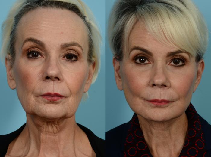 Dr. Sinno Facelift in Chicago, Illinois