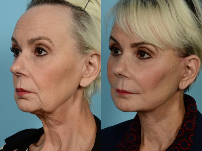 Dr. Sinno Facelift in Chicago, Illinois