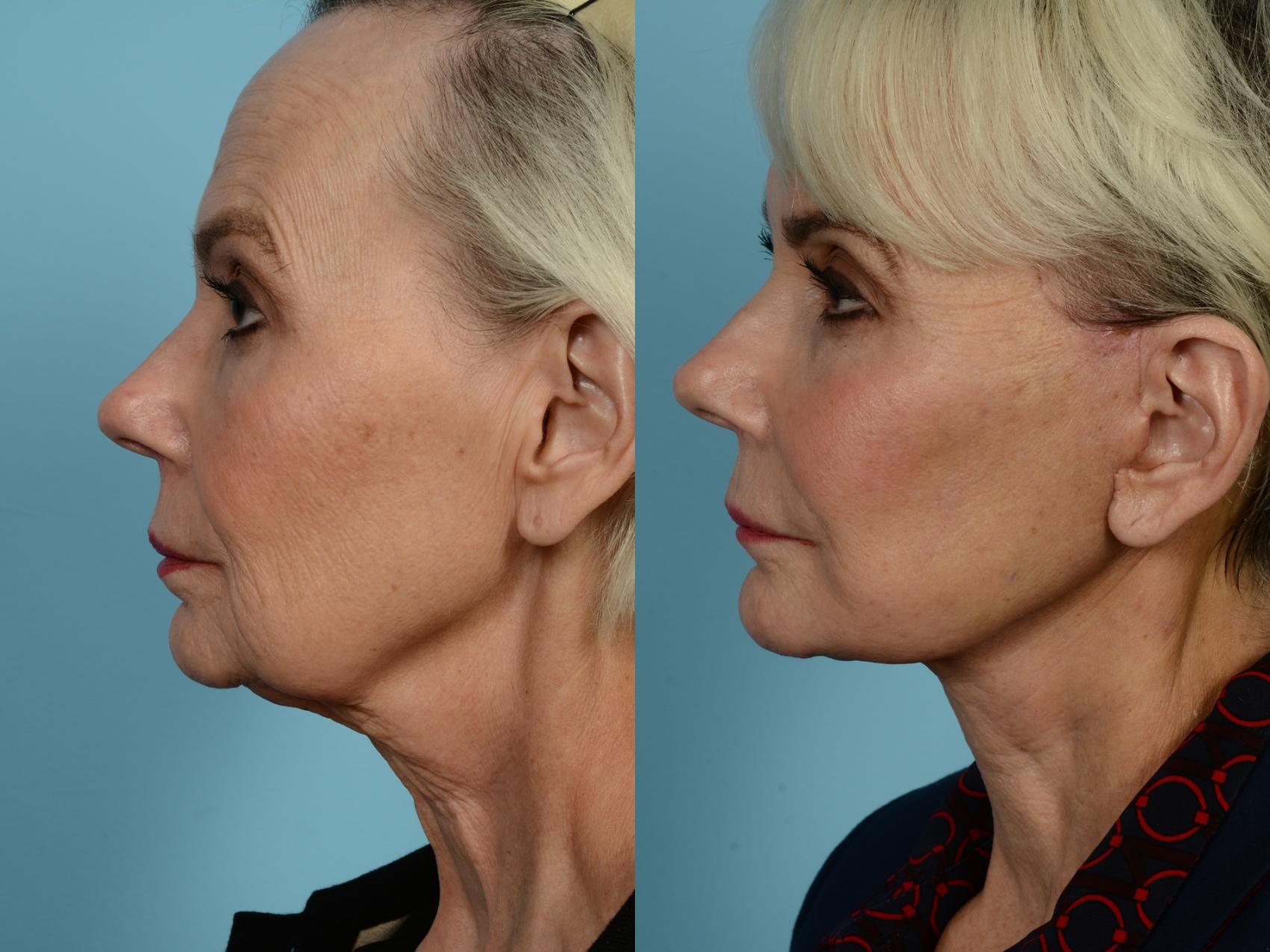 Dr. Sinno Facelift in Chicago, Illinois