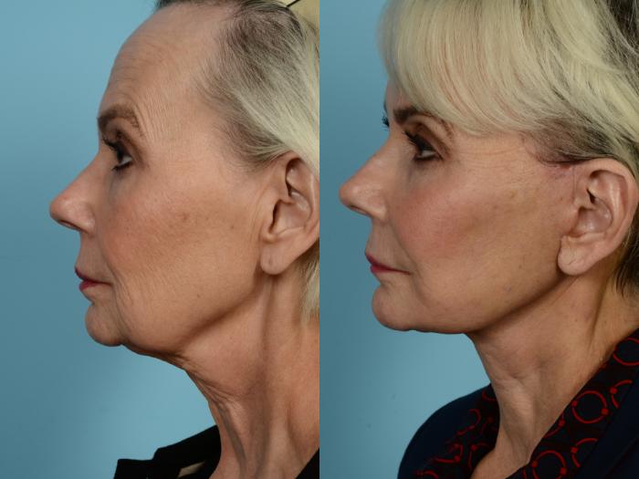 Dr. Sinno Facelift in Chicago, Illinois