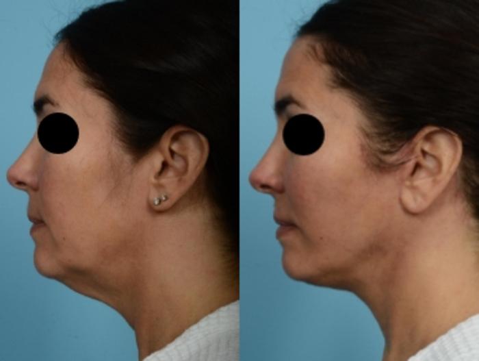 Dr. Sinno Facelift in Chicago, Illinois