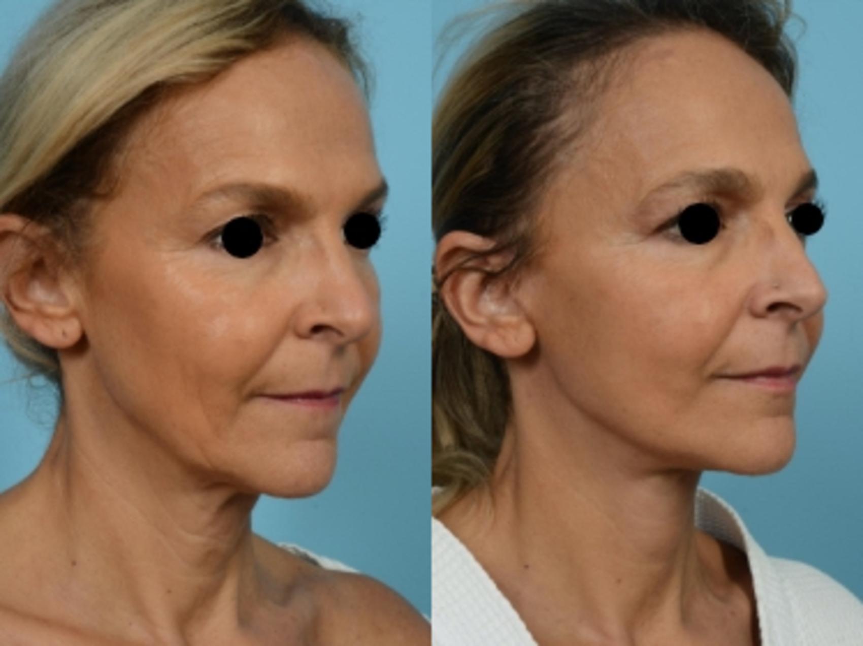 Dr. Sinno Facelift in Chicago, Illinois