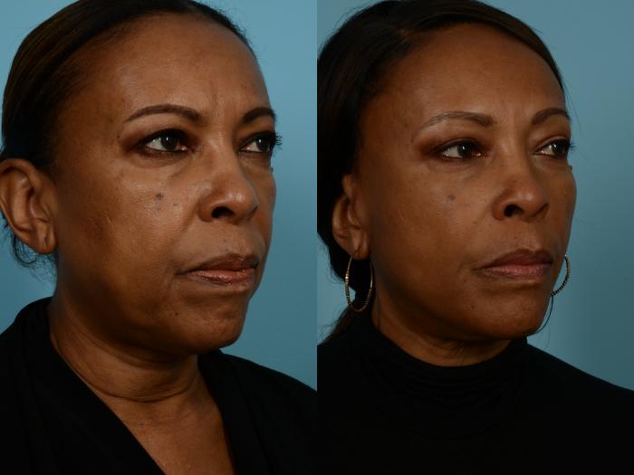 Before & After Dual Plane Facelift by Dr. Sinno Case 690 Right Oblique View in Chicago, IL