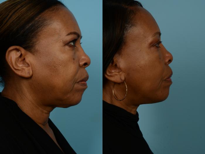 Before & After Dual Plane Facelift by Dr. Sinno Case 690 Right Side View in Chicago, IL