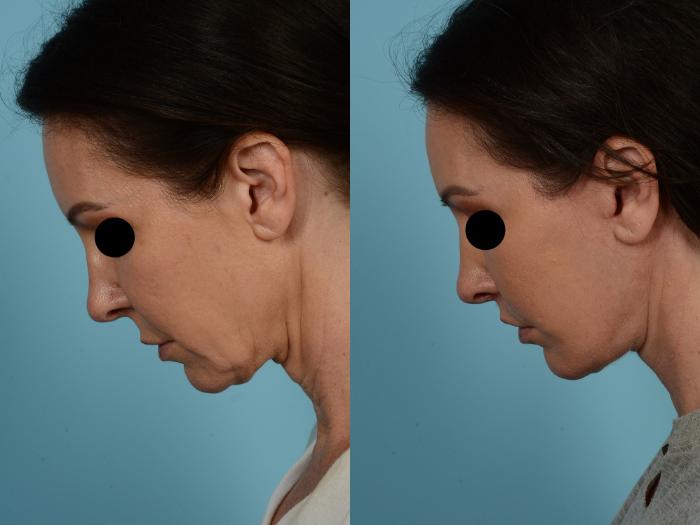 Dr. Sinno Facelift in Chicago, Illinois