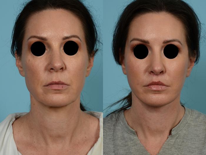 Dr. Sinno Facelift in Chicago, Illinois