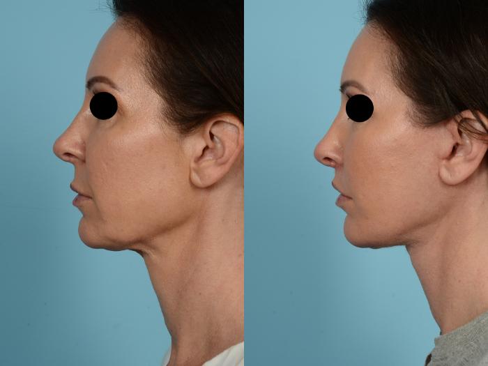 Dr. Sinno Facelift in Chicago, Illinois