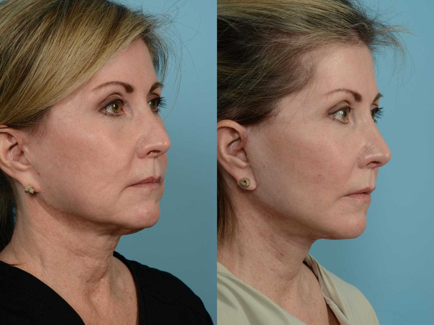 Dr. Sinno Facelift in Chicago, Illinois