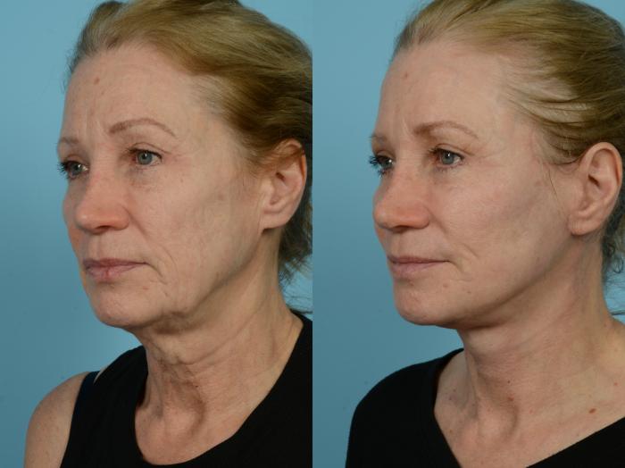 Dr. Sinno Facelift in Chicago, Illinois