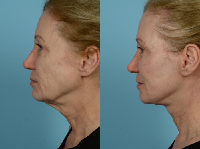Dr. Sinno Facelift in Chicago, Illinois