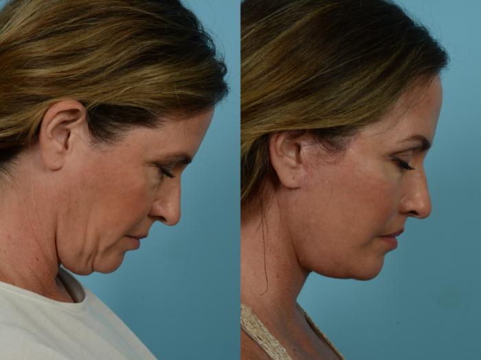 Dr. Sinno Facelift in Chicago, Illinois