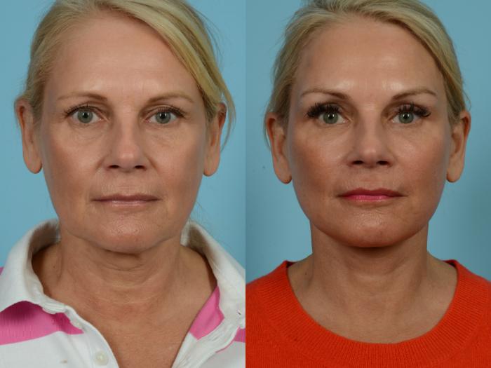 Before & After Dual Plane Facelift by Dr. Sinno Case 781 Front View in Chicago, IL