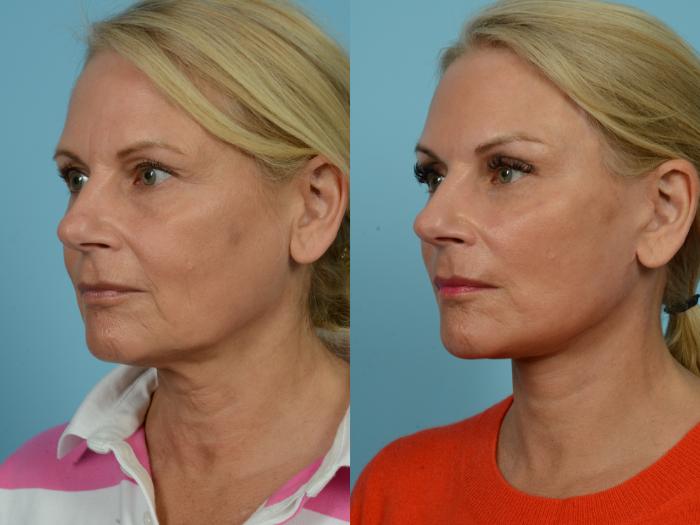 Before & After Dual Plane Facelift by Dr. Sinno Case 781 Left Oblique View in Chicago, IL