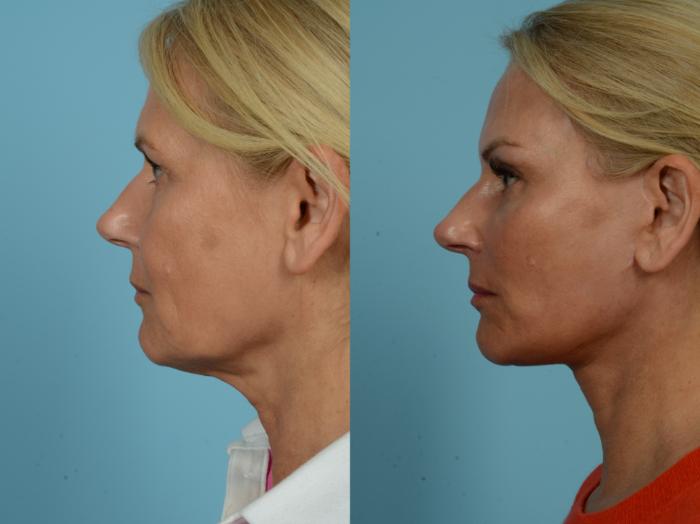 Before & After Dual Plane Facelift by Dr. Sinno Case 781 Left Side View in Chicago, IL