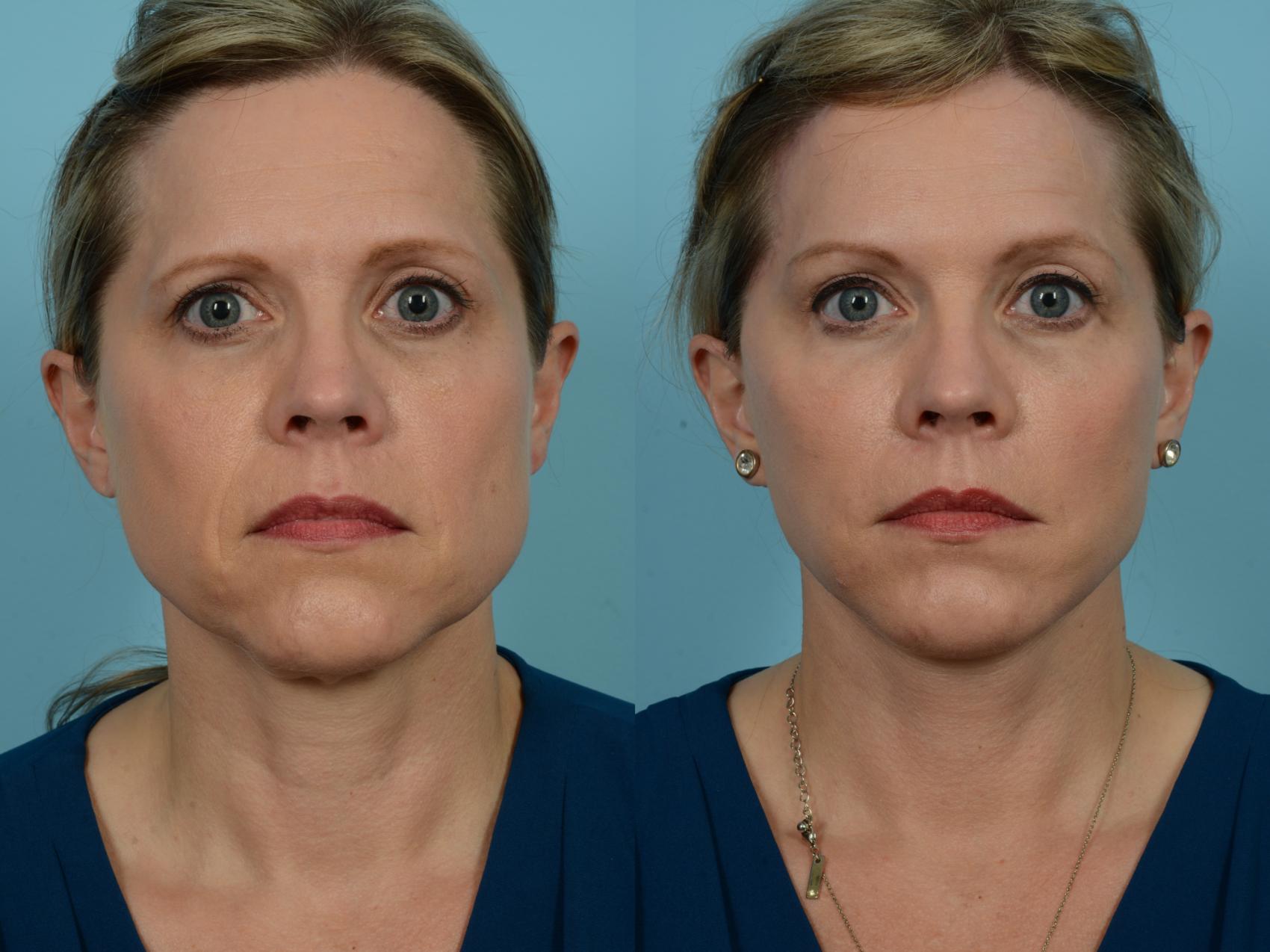 Before & After Dual Plane Facelift by Dr. Sinno Case 784 Front View in Chicago, IL