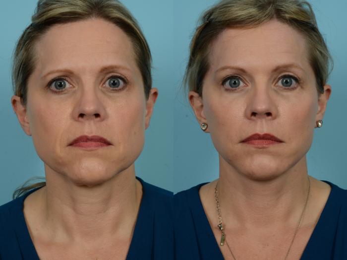 Before & After Dual Plane Facelift by Dr. Sinno Case 784 Front View in Chicago, IL