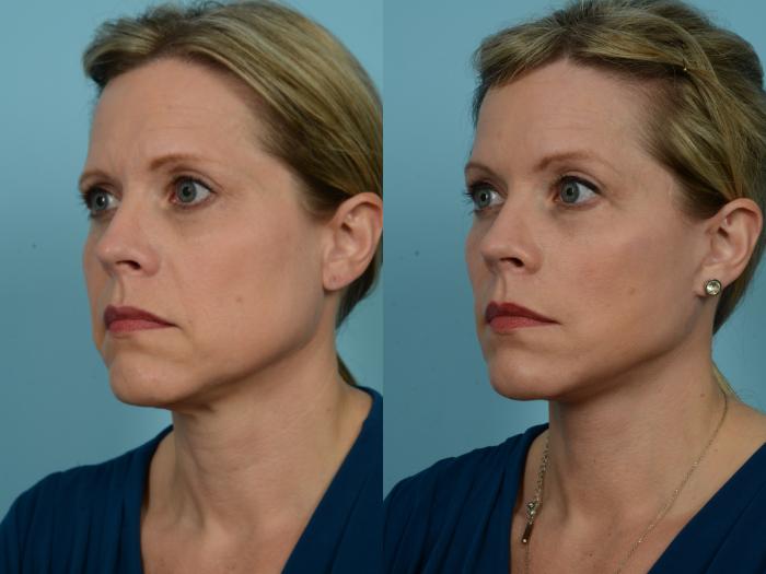 Before & After Dual Plane Facelift by Dr. Sinno Case 784 Left Oblique View in Chicago, IL